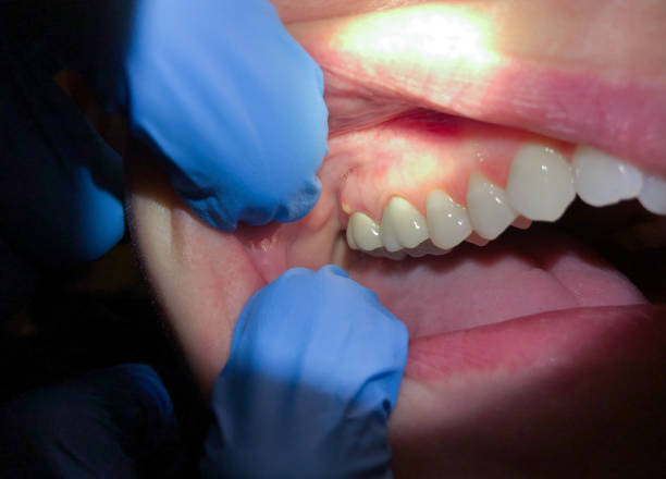 Best Emergency Wisdom Tooth Extraction in Waldorf, MD